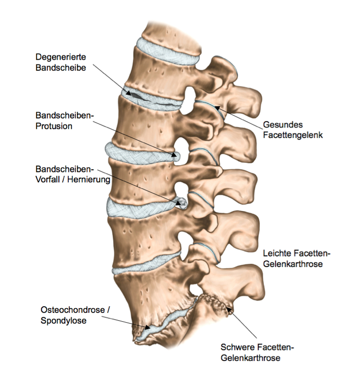 Wie sieh die Osteochondrose aus