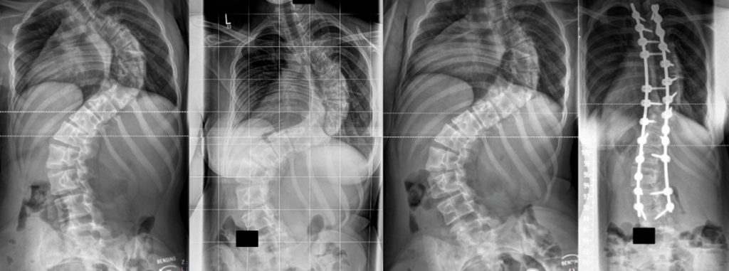 Erwachsenenskoliose Koller Wirbelsäule Ihr Spezialist für